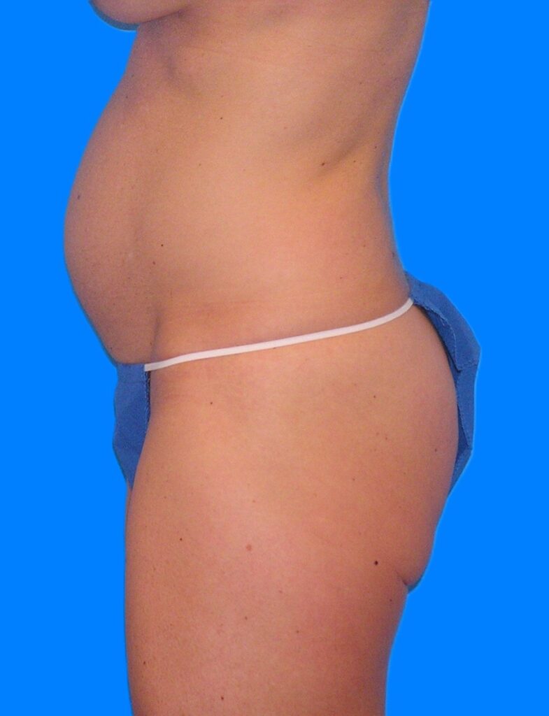 Before Image: Patient Case #1164 - left-side