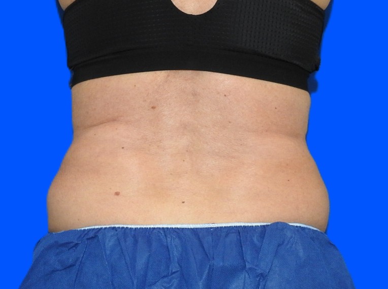 Before Image: Patient Case #1164 - back