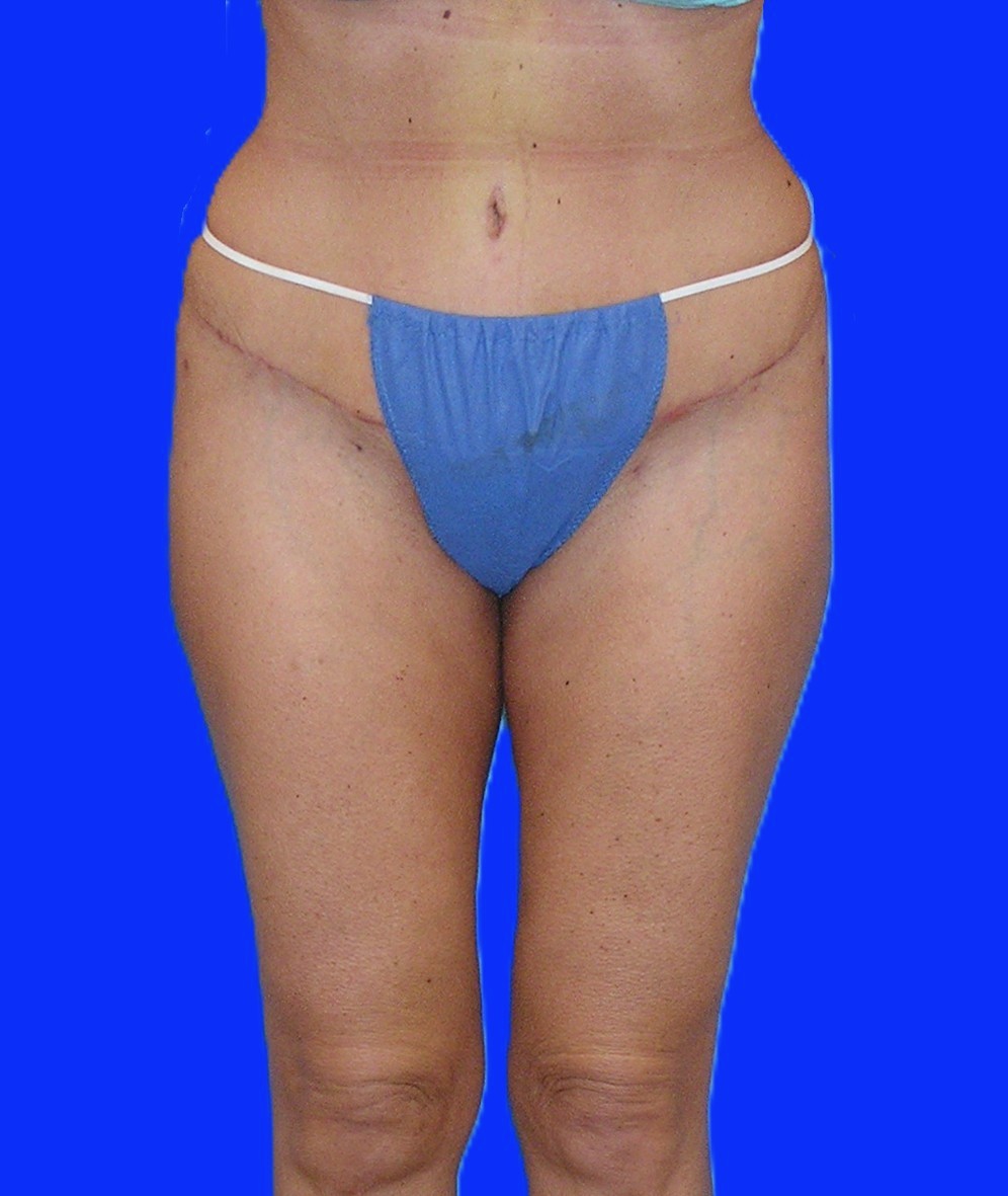 After Image: Patient Case #1060 & 1165 - front