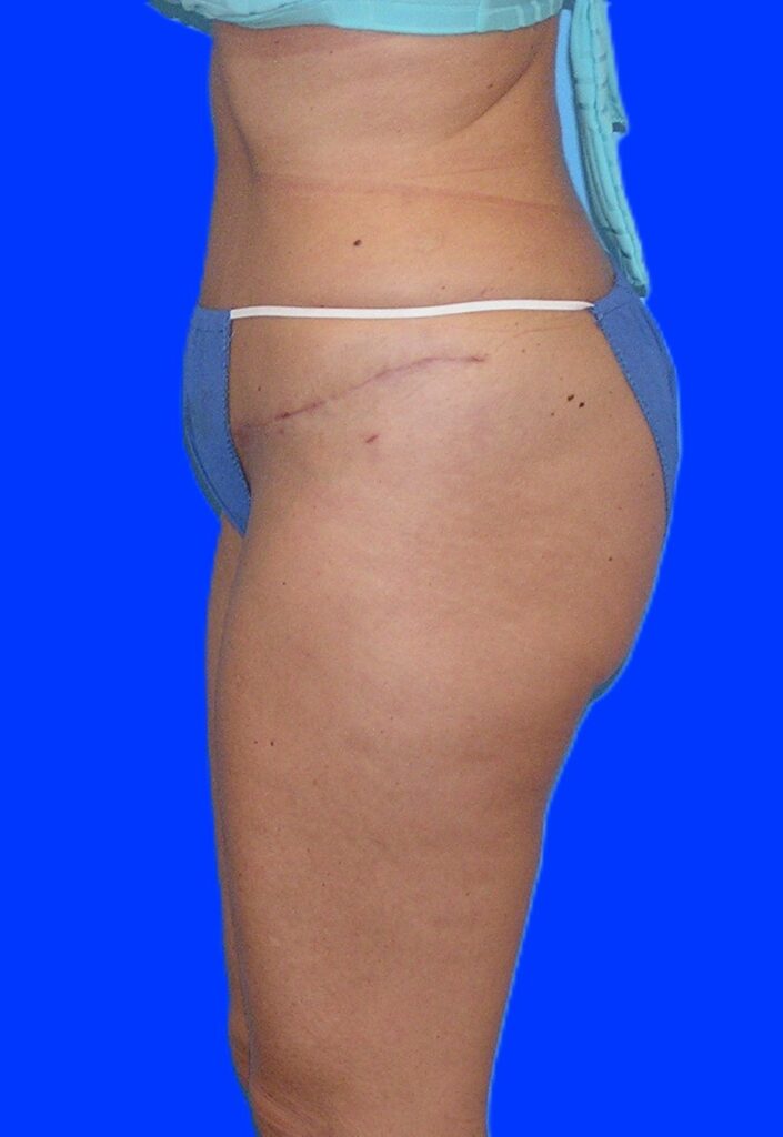 After Image: Patient Case #1060 & 1165 - left-side