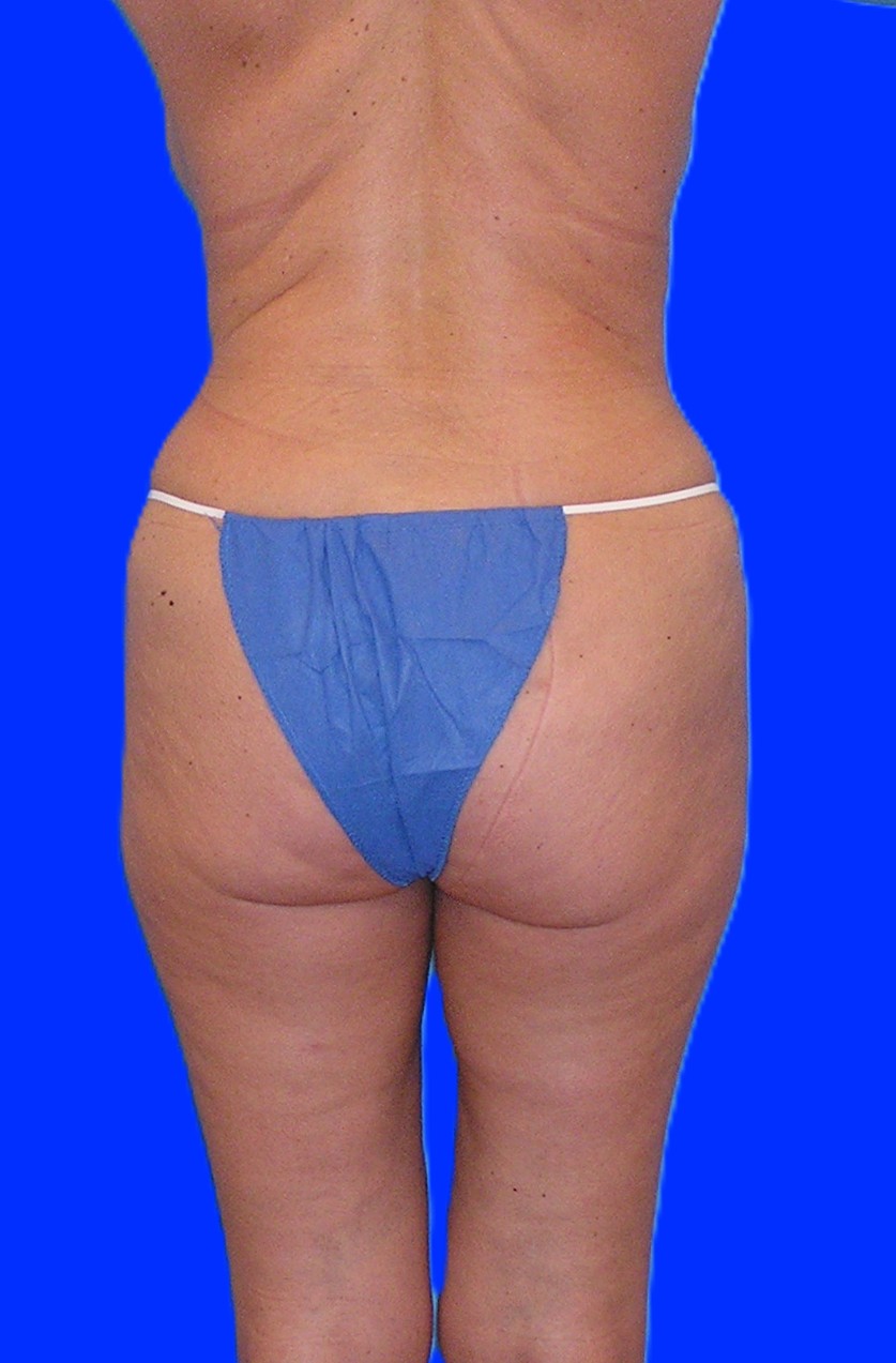 After Image: Patient Case #1060 & 1165 - back