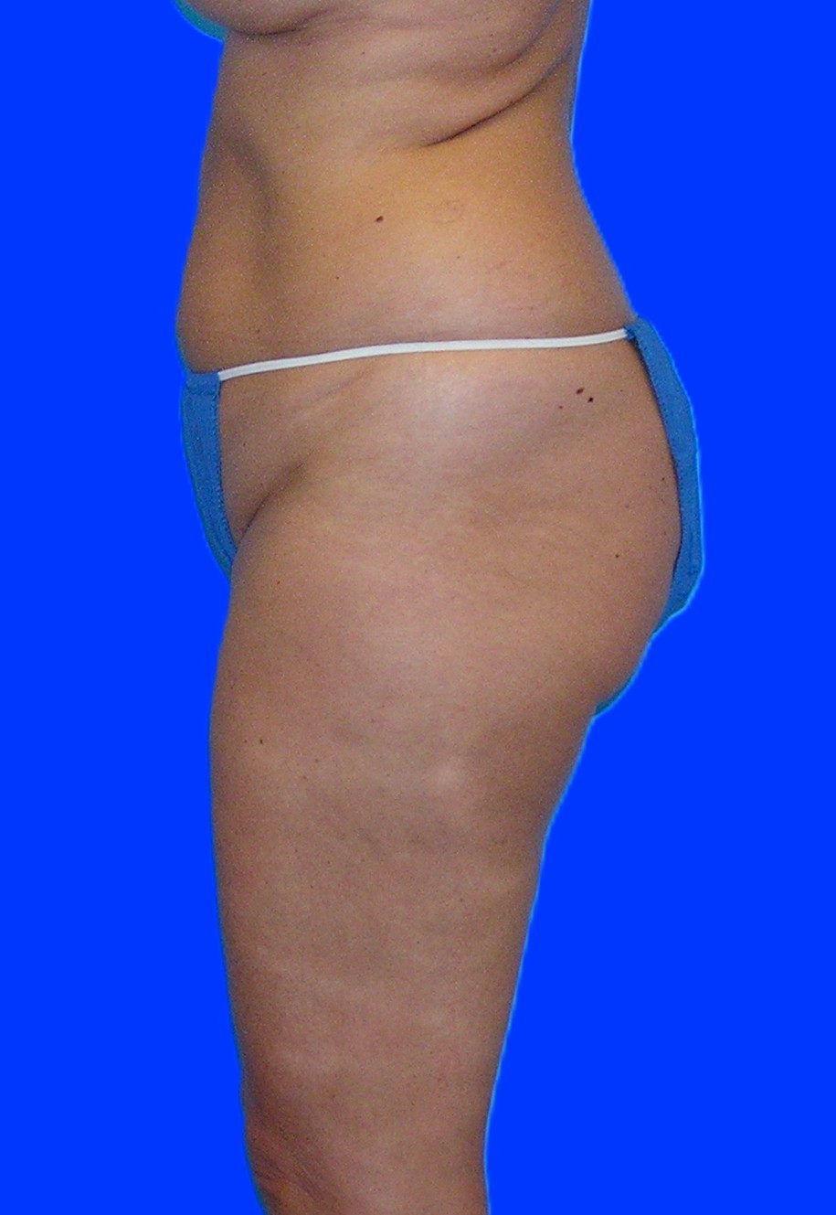 Before Image: Patient Case #1060 & 1165 - left-side