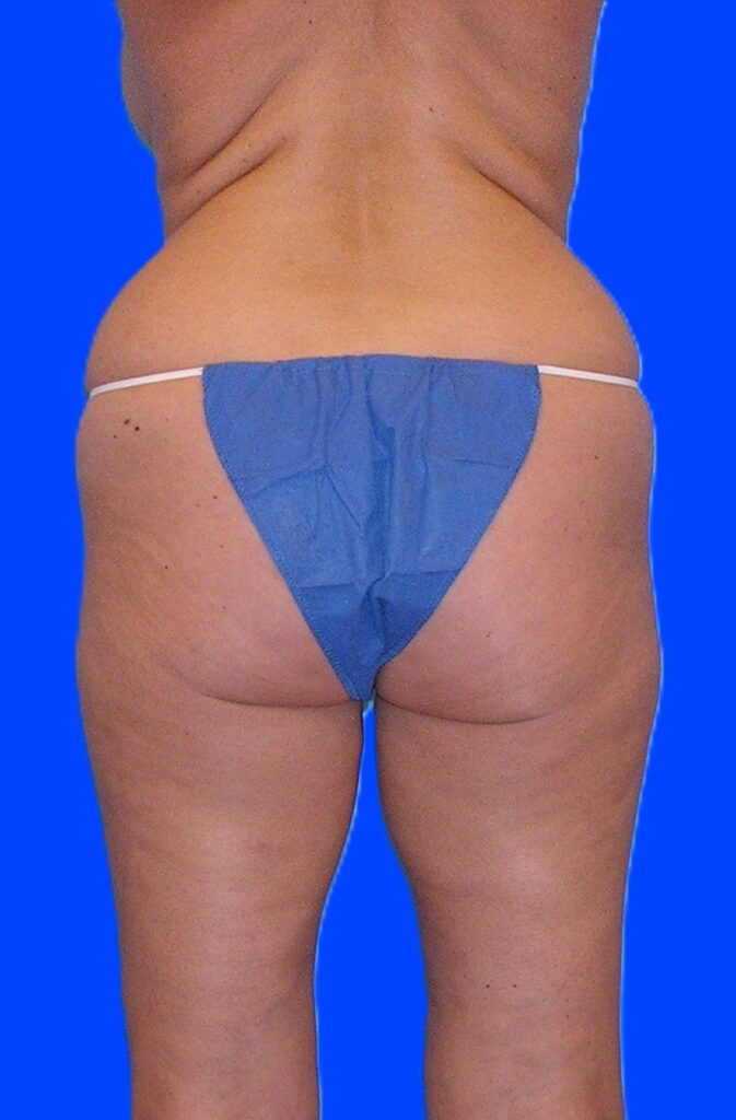 Before Image: Patient Case #1060 & 1165 - back