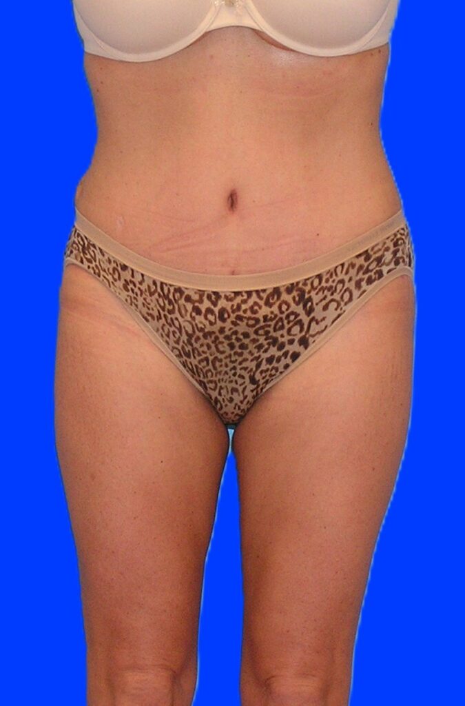 After Image: Patient Case #1166 - front