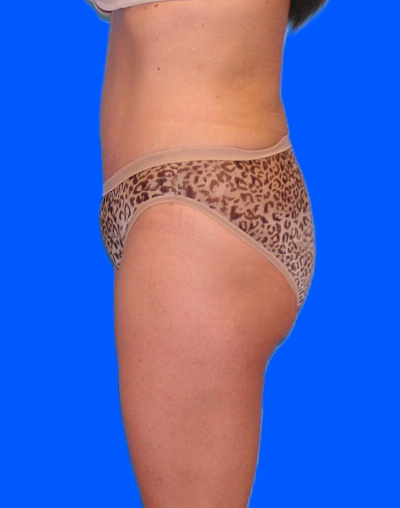 After Image: Patient Case #1166 - left-side