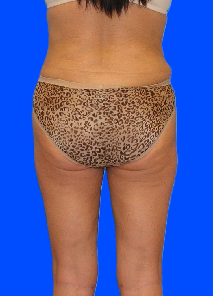 After Image: Patient Case #1166 - back