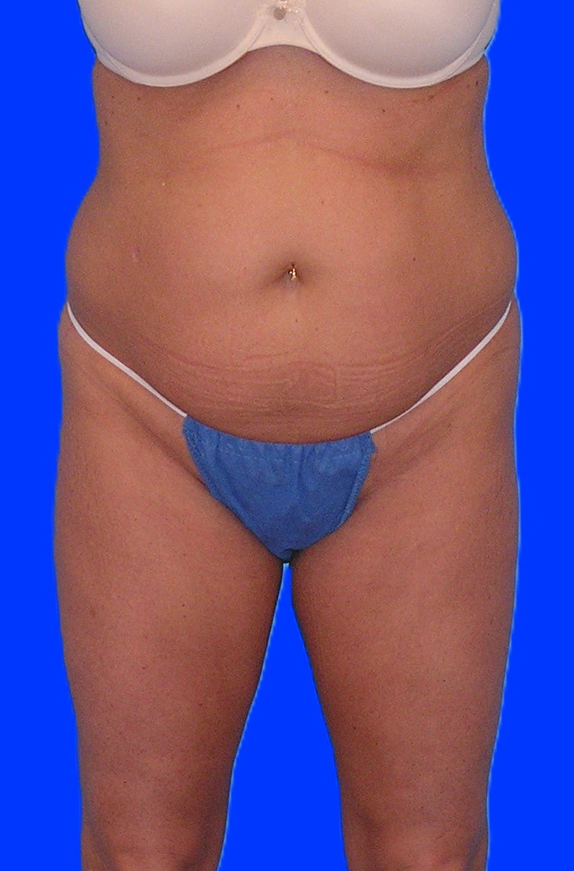 Before Image: Patient Case #1166 - front
