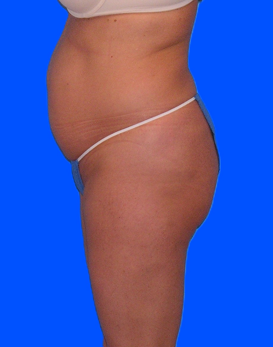 Before Image: Patient Case #1166 - left-side