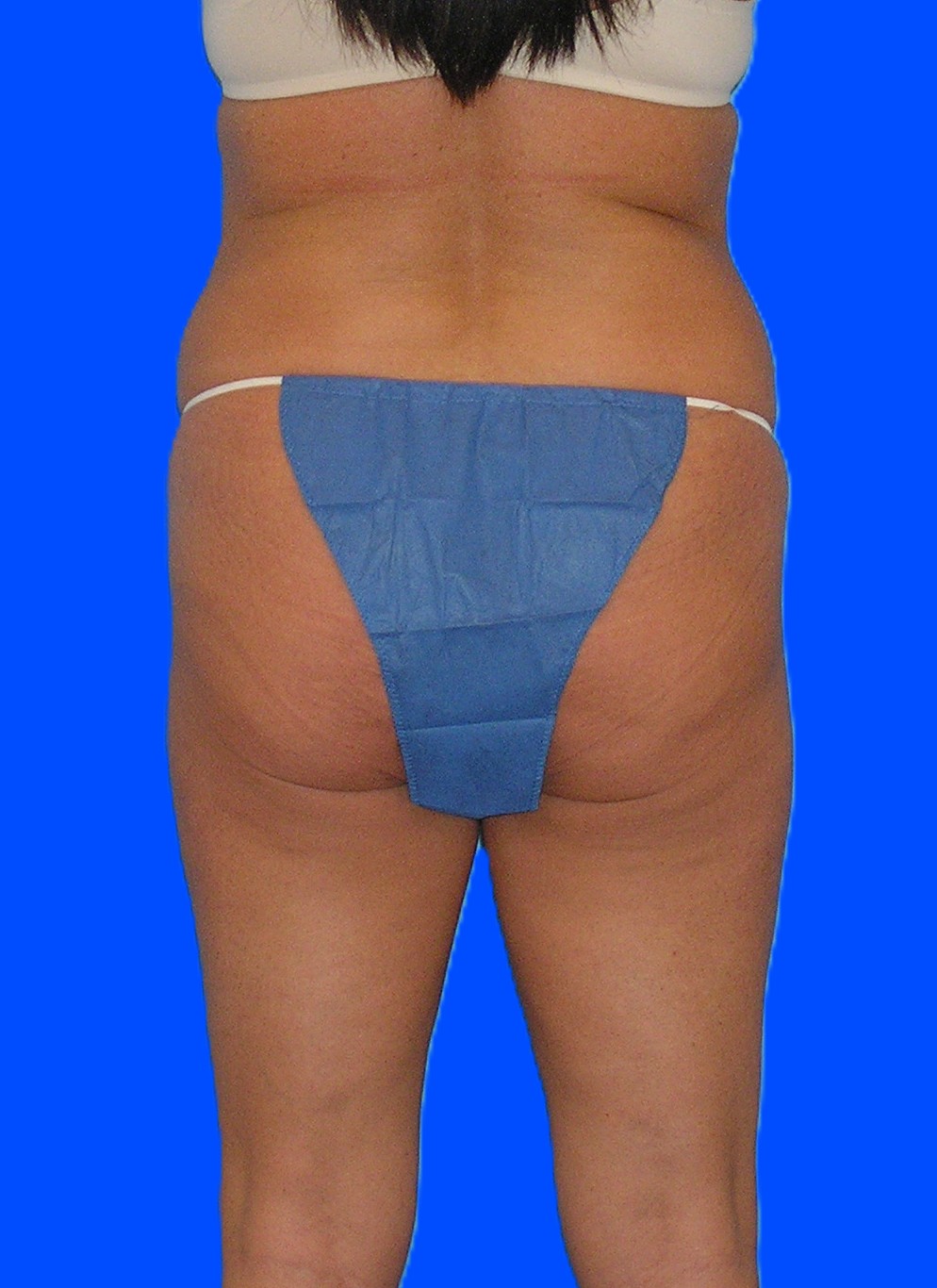 Before Image: Patient Case #1166 - back