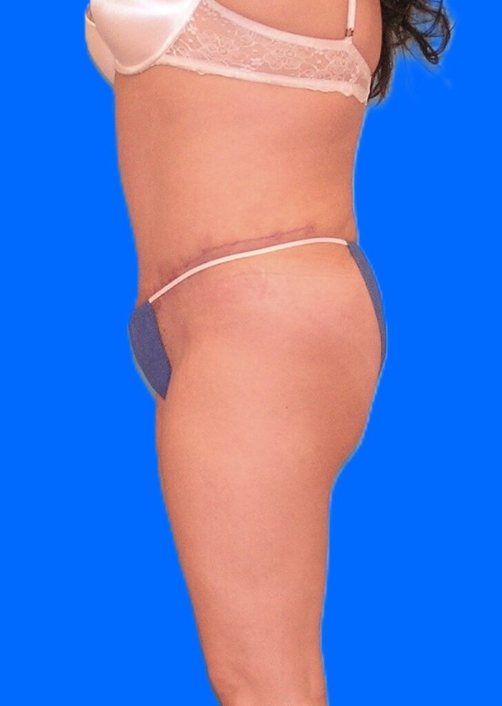 After Image: Patient Case #1167 - left-side