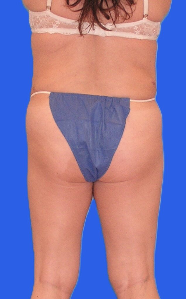 After Image: Patient Case #1167 - back