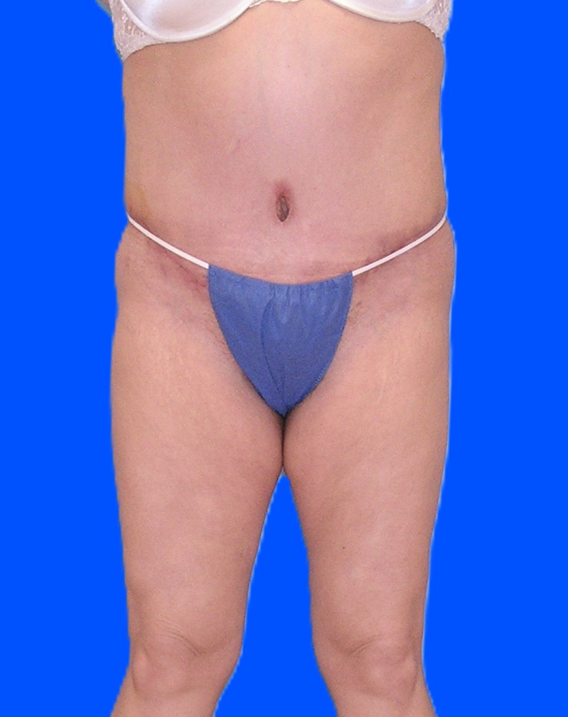 After Image: Patient Case #1167 - front