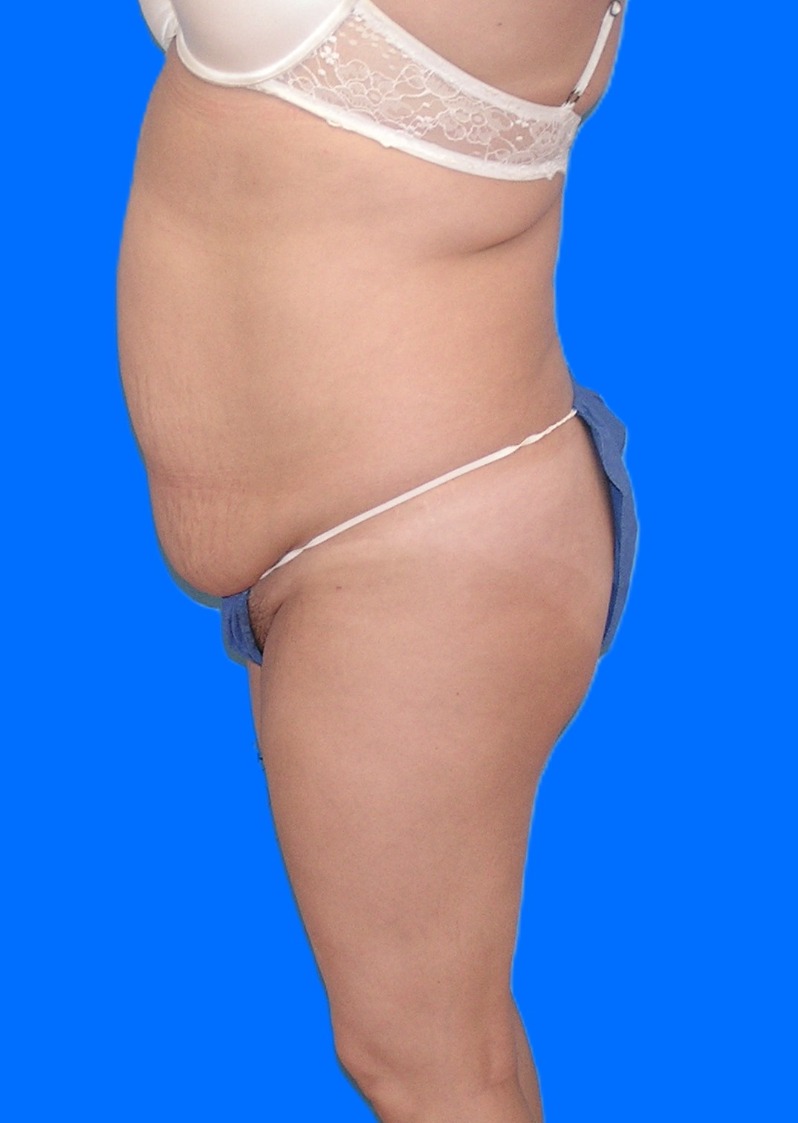 Before Image: Patient Case #1167 - left-side