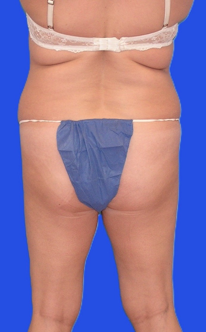 Before Image: Patient Case #1167 - back