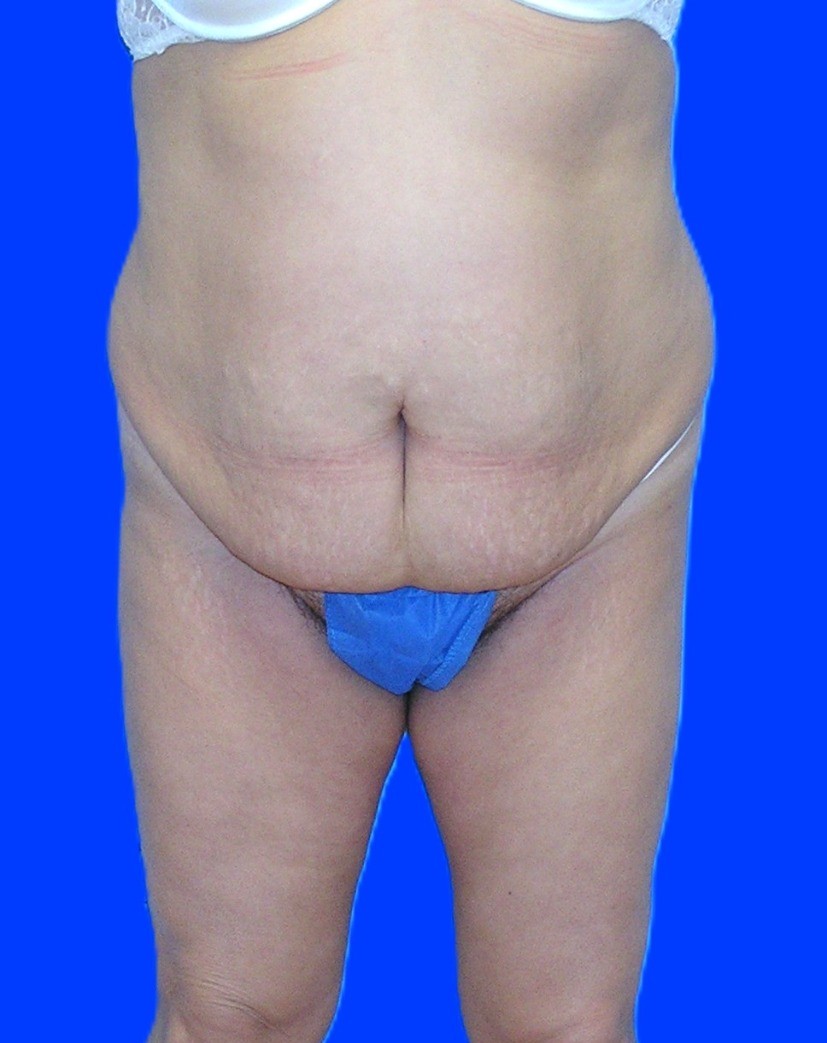 Before Image: Patient Case #1167 - front