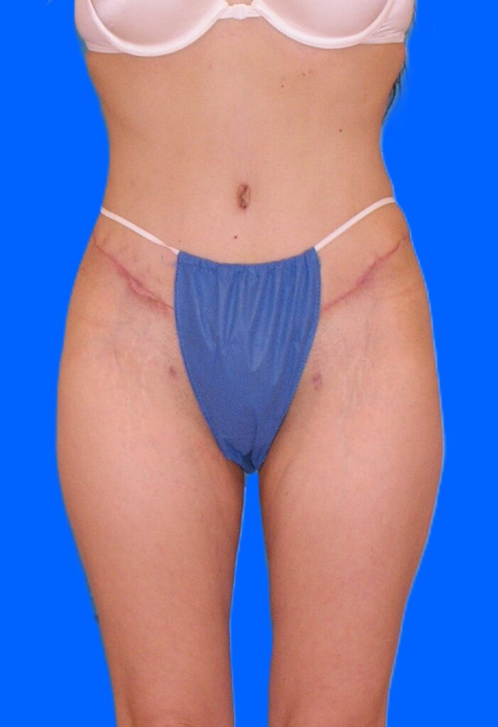 After Image: Patient Case #1168 - front