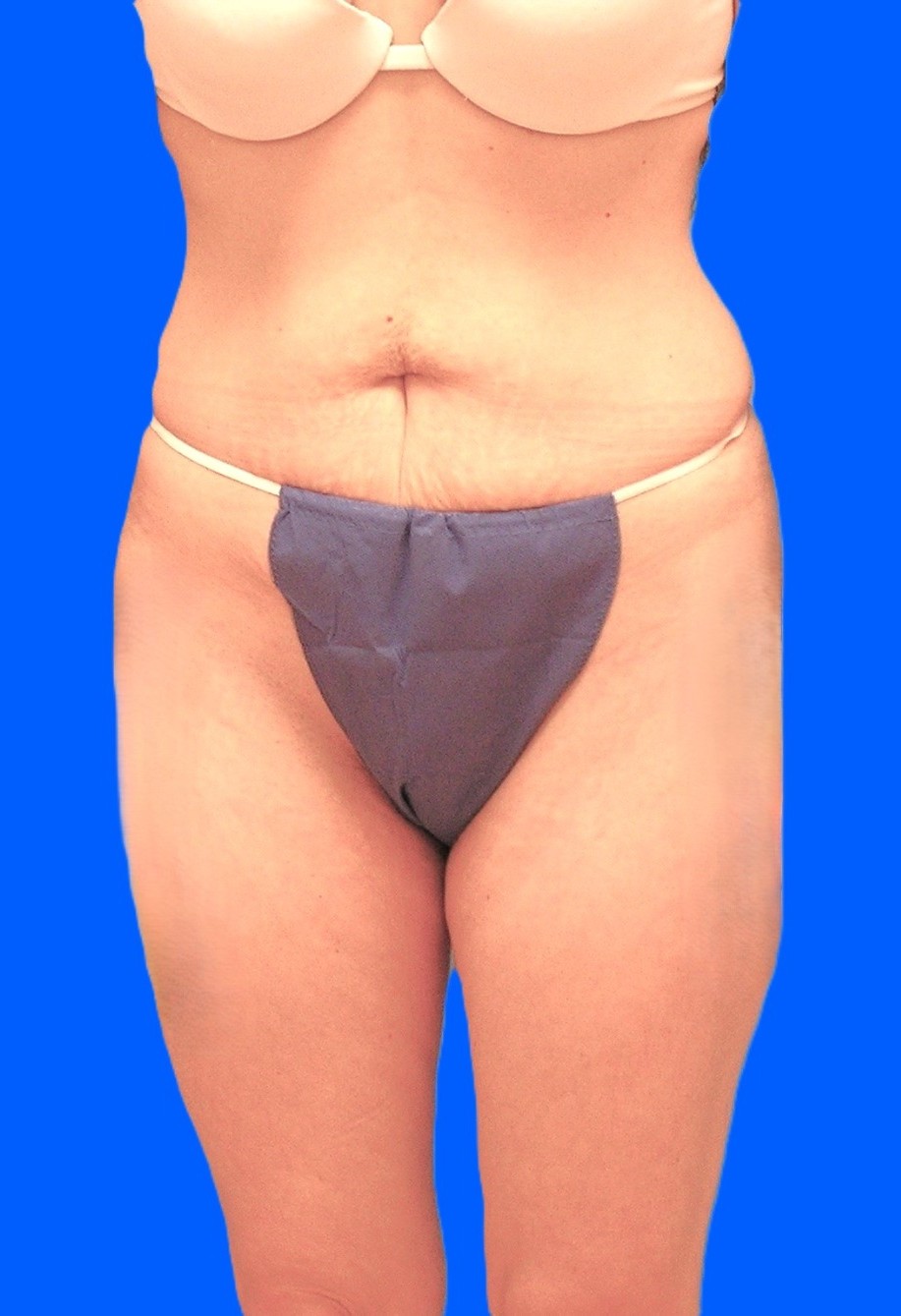 Before Image: Patient Case #1168 - front