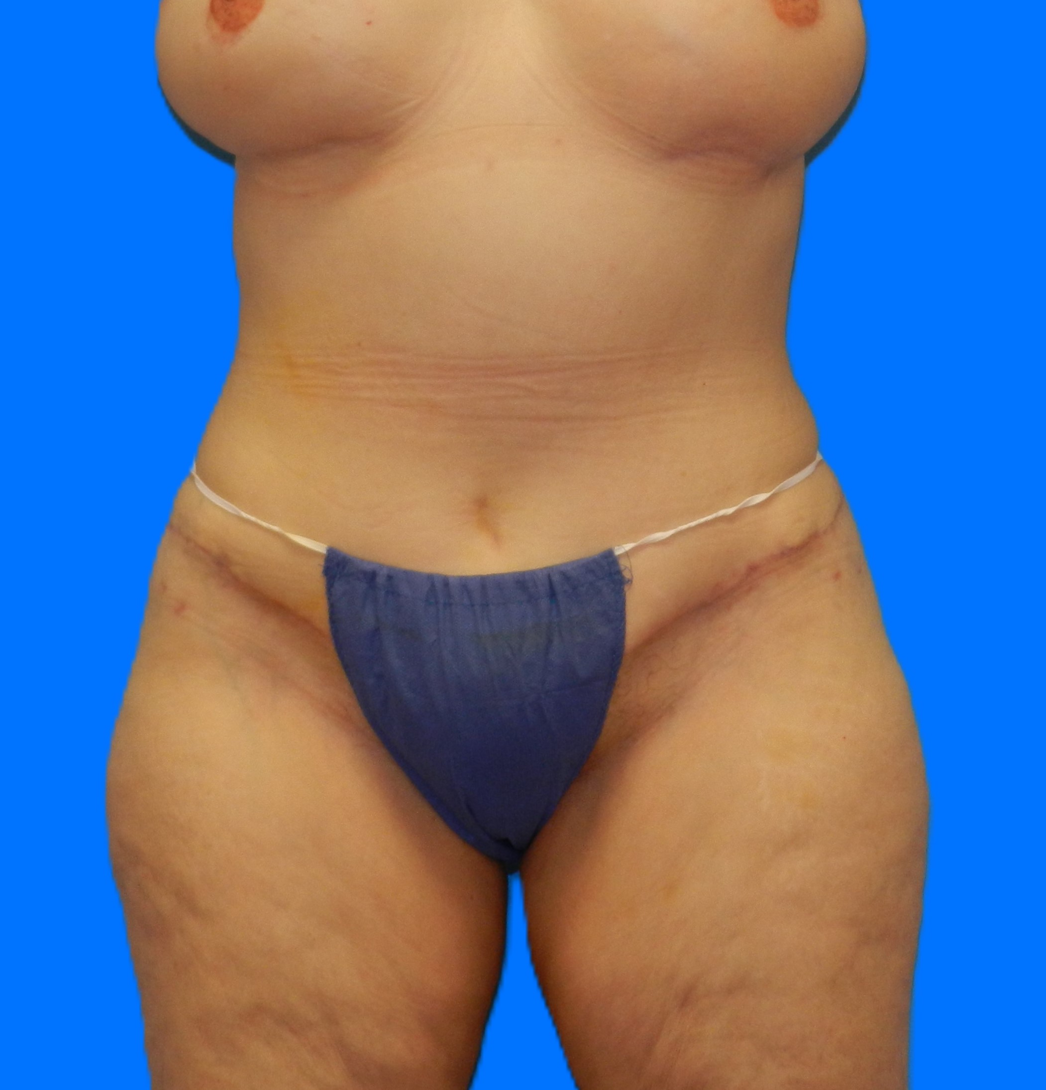 After Image: Patient Case #1169 - front
