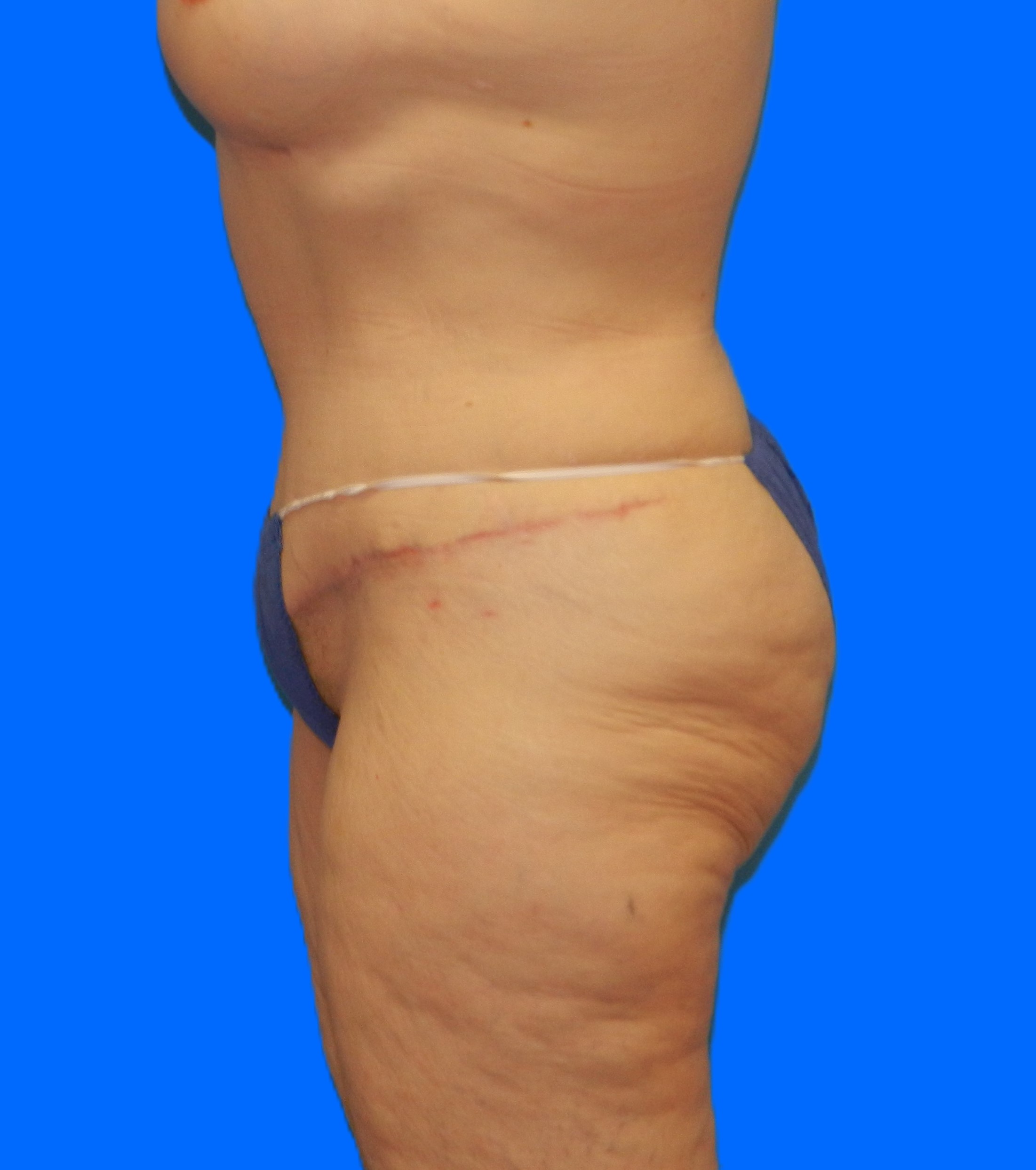 After Image: Patient Case #1169 - left-side