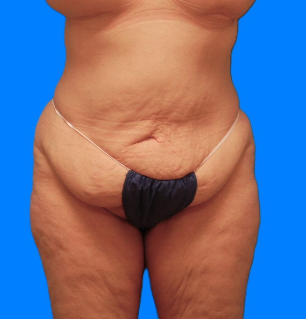Before Image: Patient Case #1169 - front