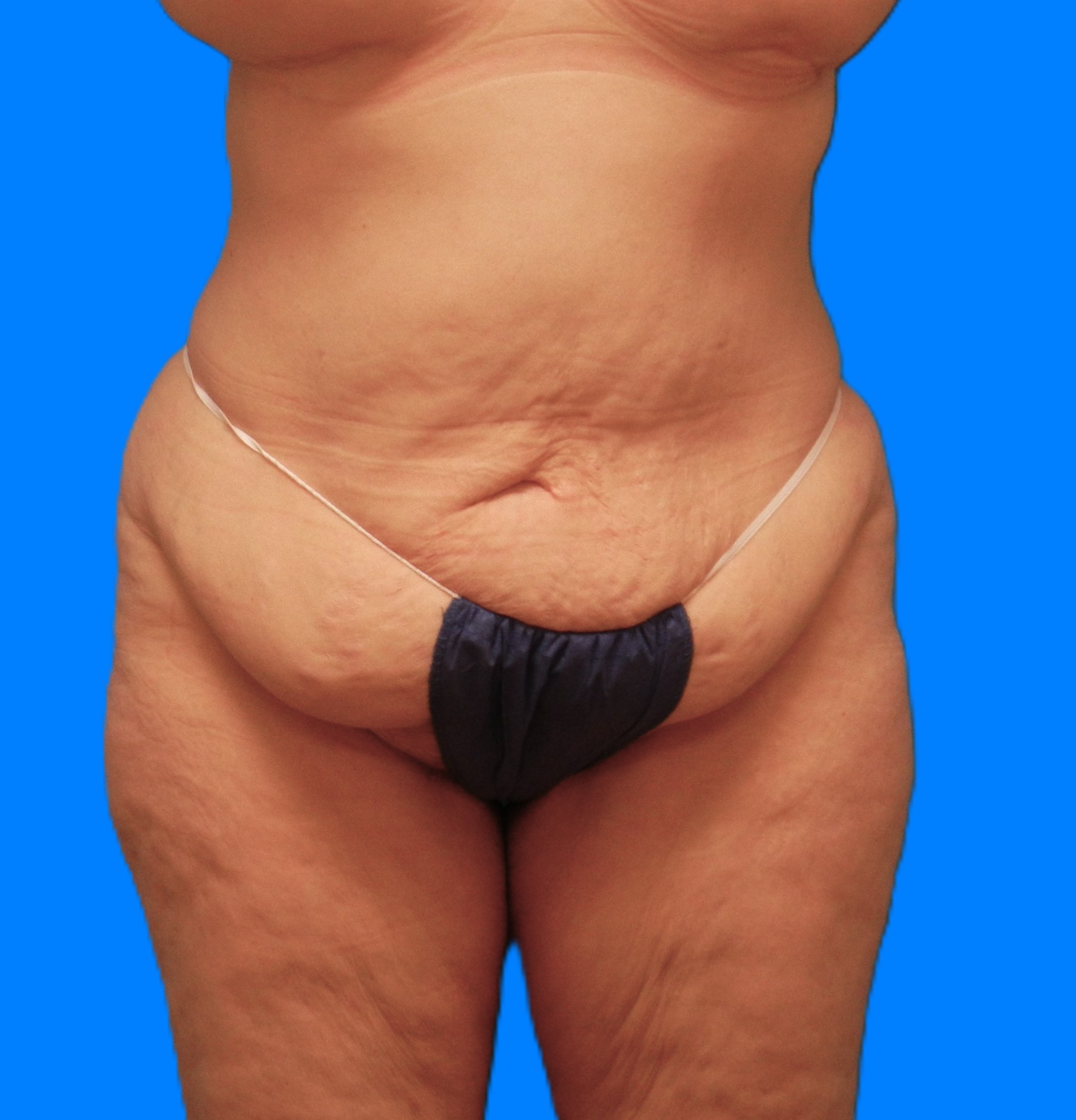 Before Image: Patient Case #1169 - front