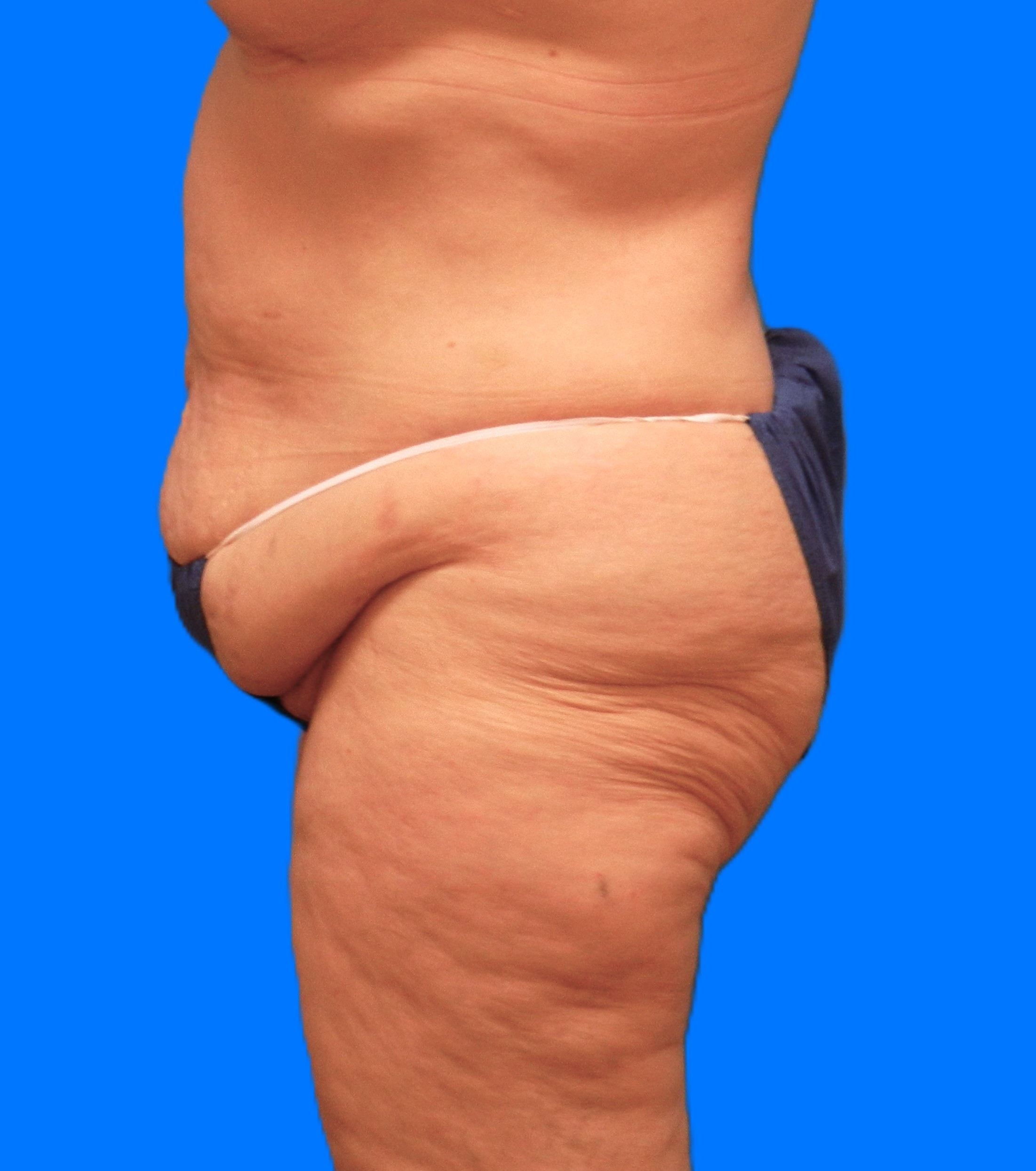 Before Image: Patient Case #1169 - left-side