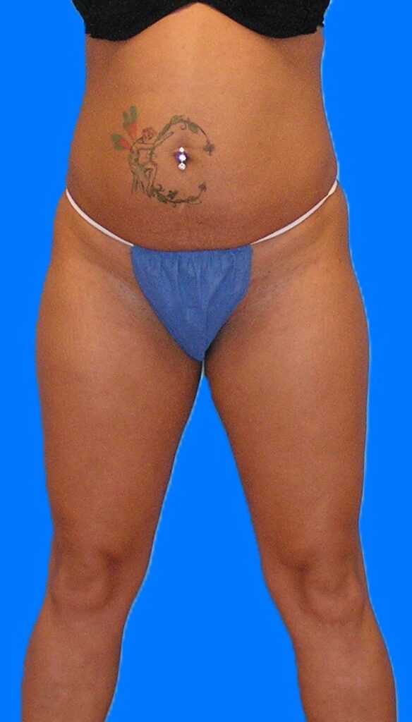 Before Image: Patient Case #1172 - front