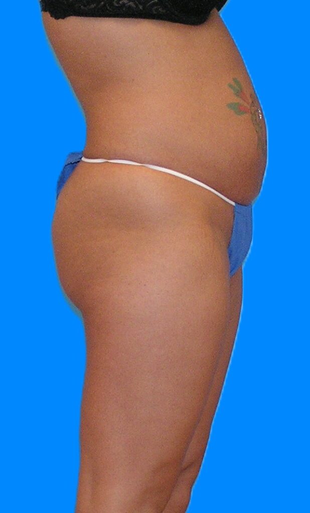 Before Image: Patient Case #1172 - right-side