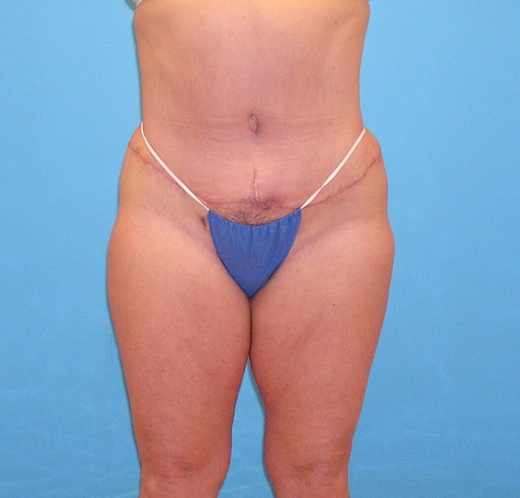 After Image: Patient Case #1175 - front
