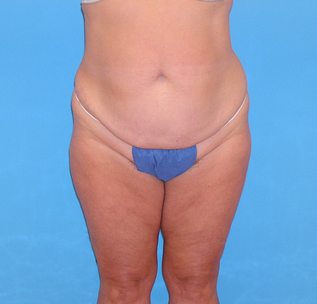 Before Image: Patient Case #1175 - front
