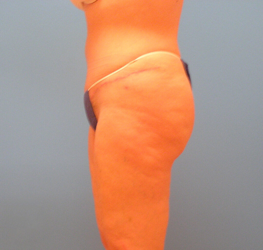 After Image: Patient Case #1176 - left-side