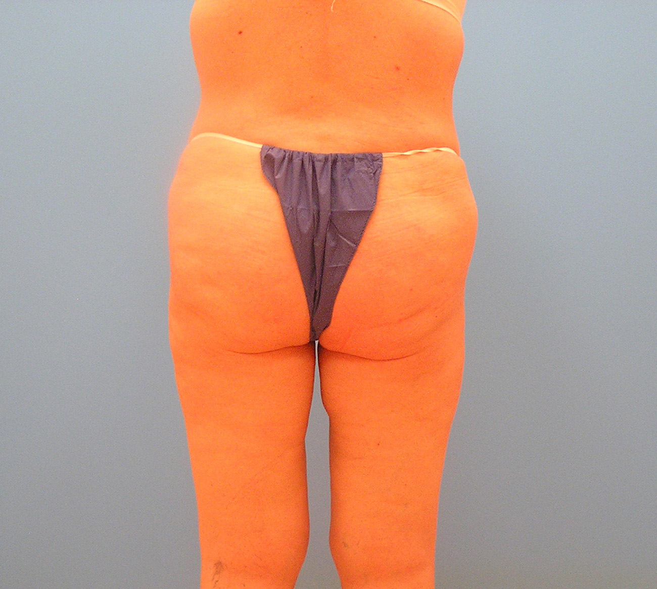 After Image: Patient Case #1176 - back