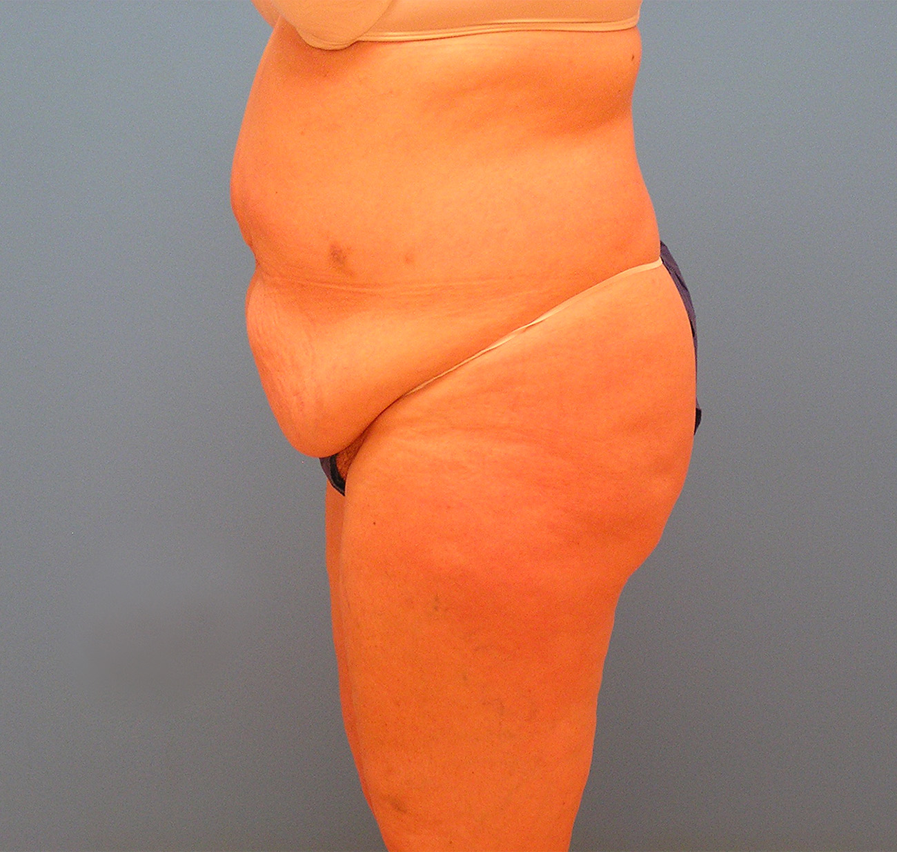 Before Image: Patient Case #1176 - left-side