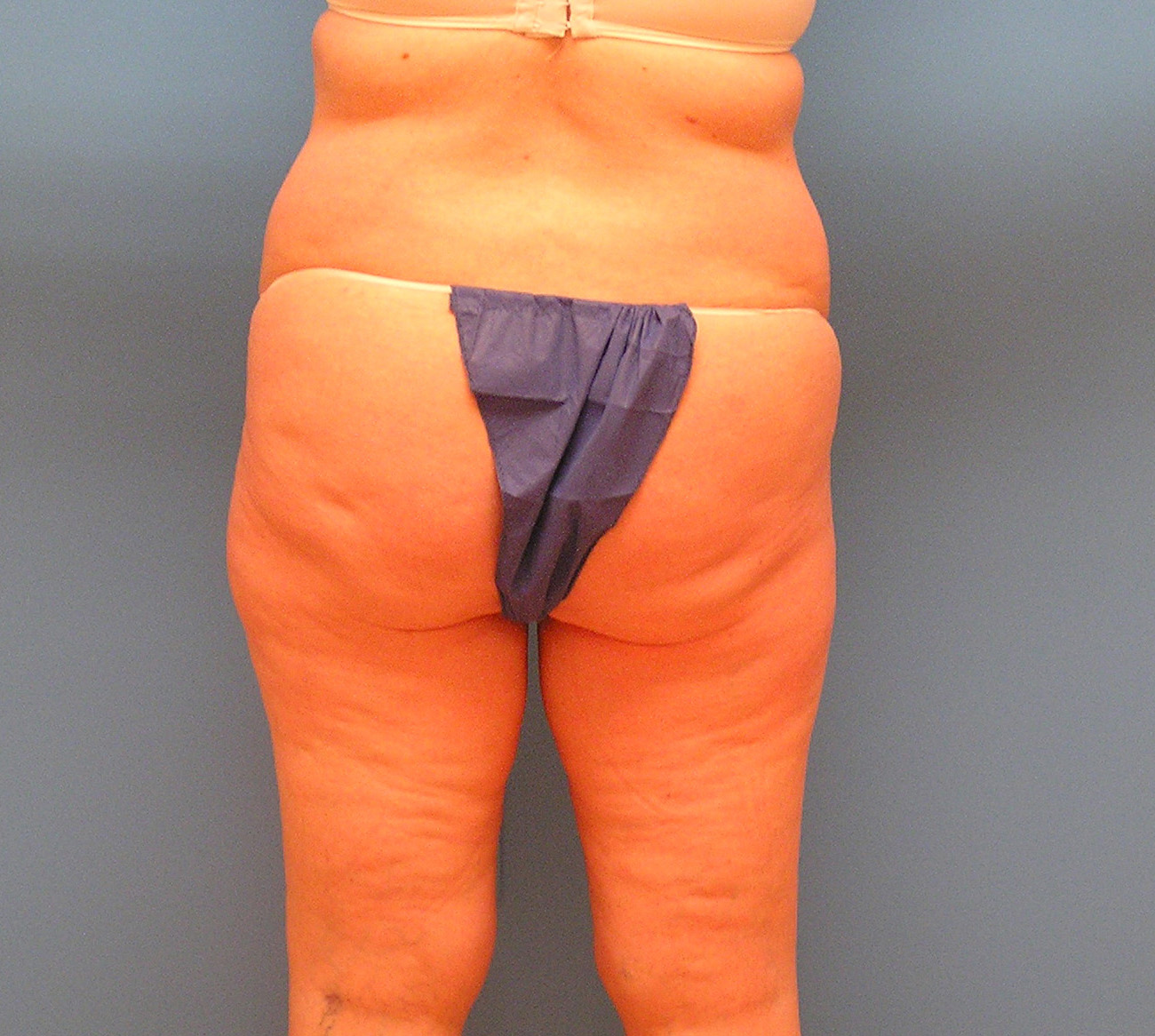 Before Image: Patient Case #1176 - back