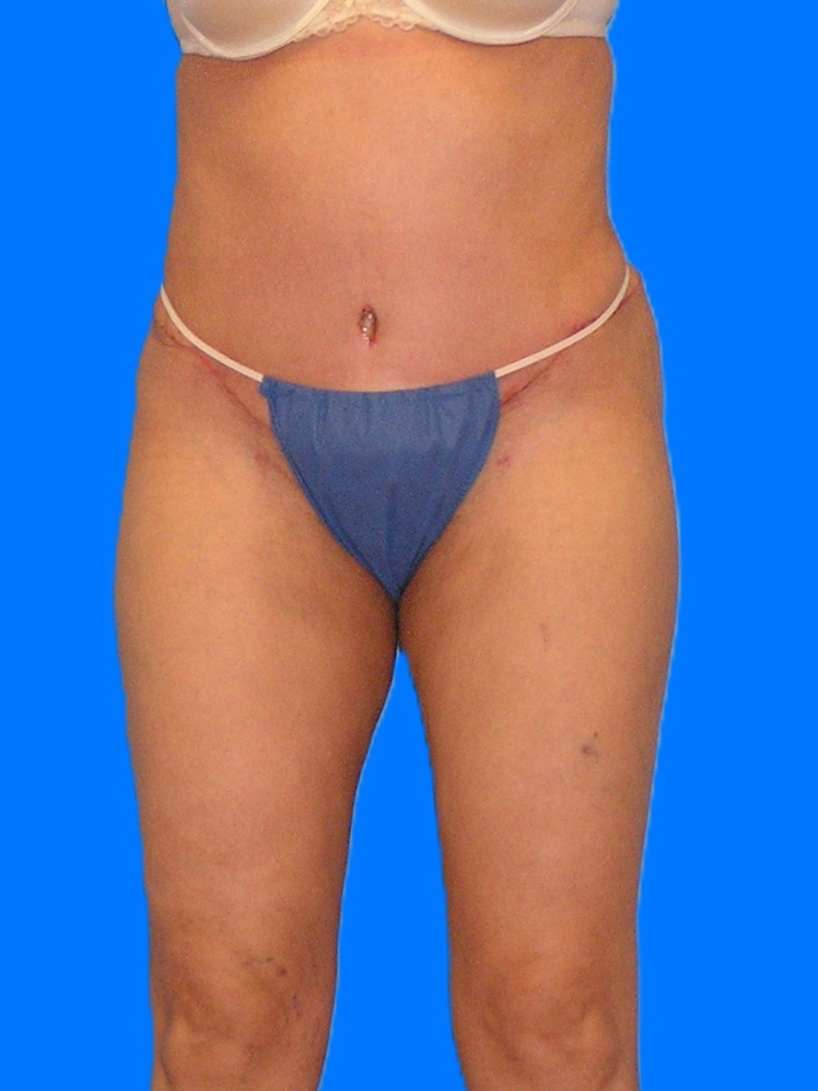 After Image: Patient Case #1179 - front