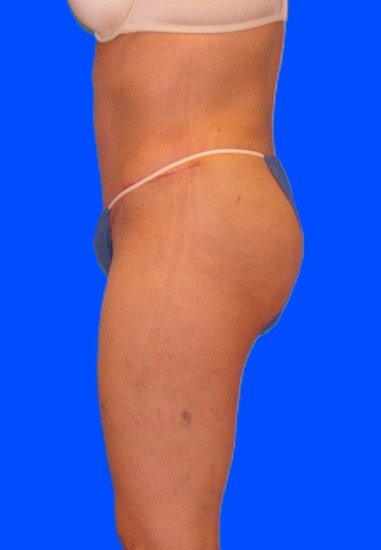 After Image: Patient Case #1179 - left-side