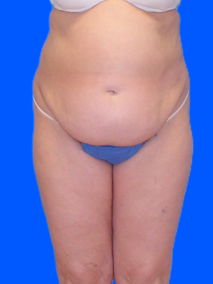 Before Image: Patient Case #1179 - front