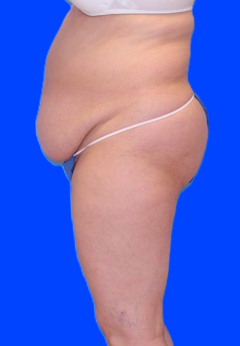 Before Image: Patient Case #1179 - left-side