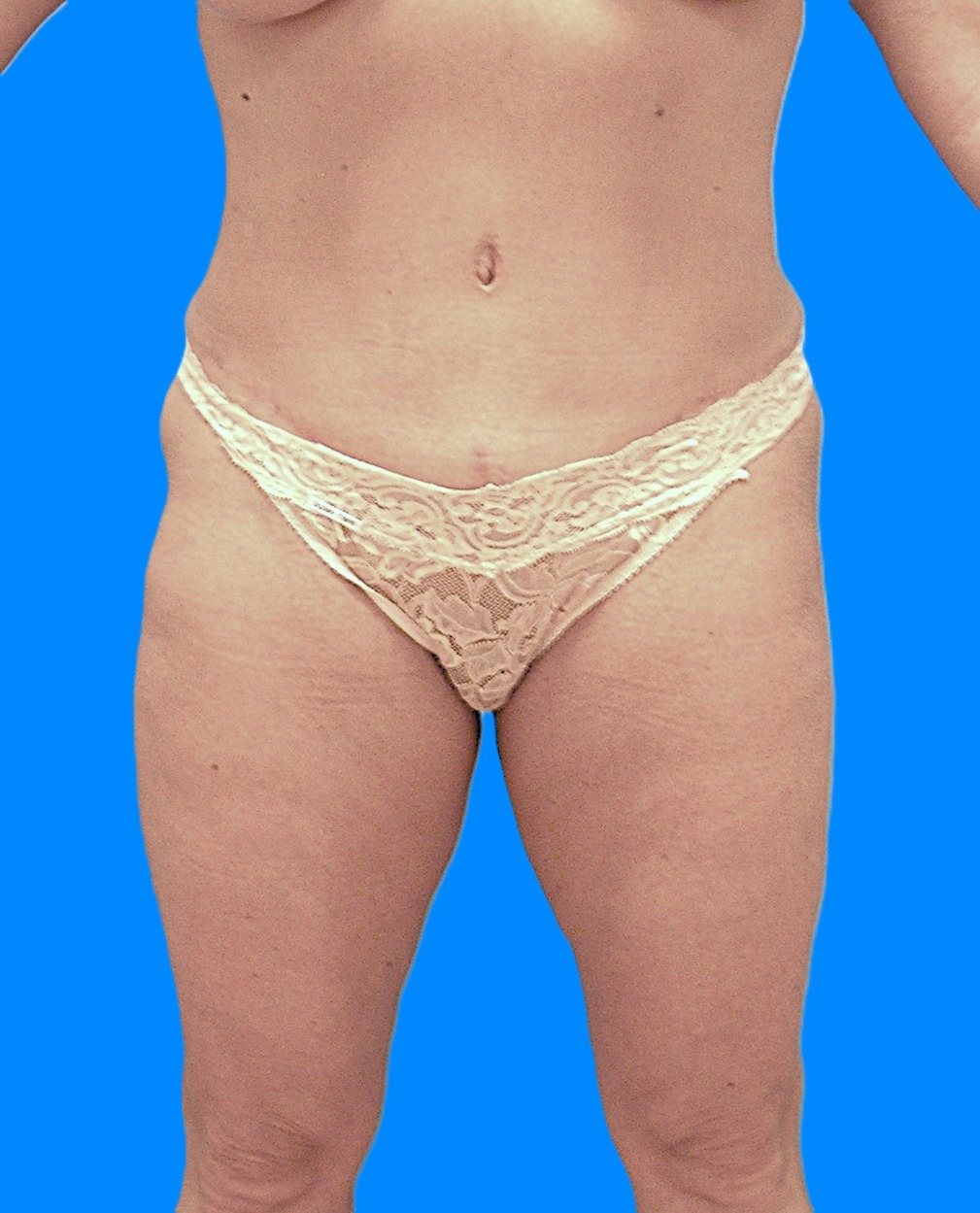 After Image: Patient Case #1182 - front