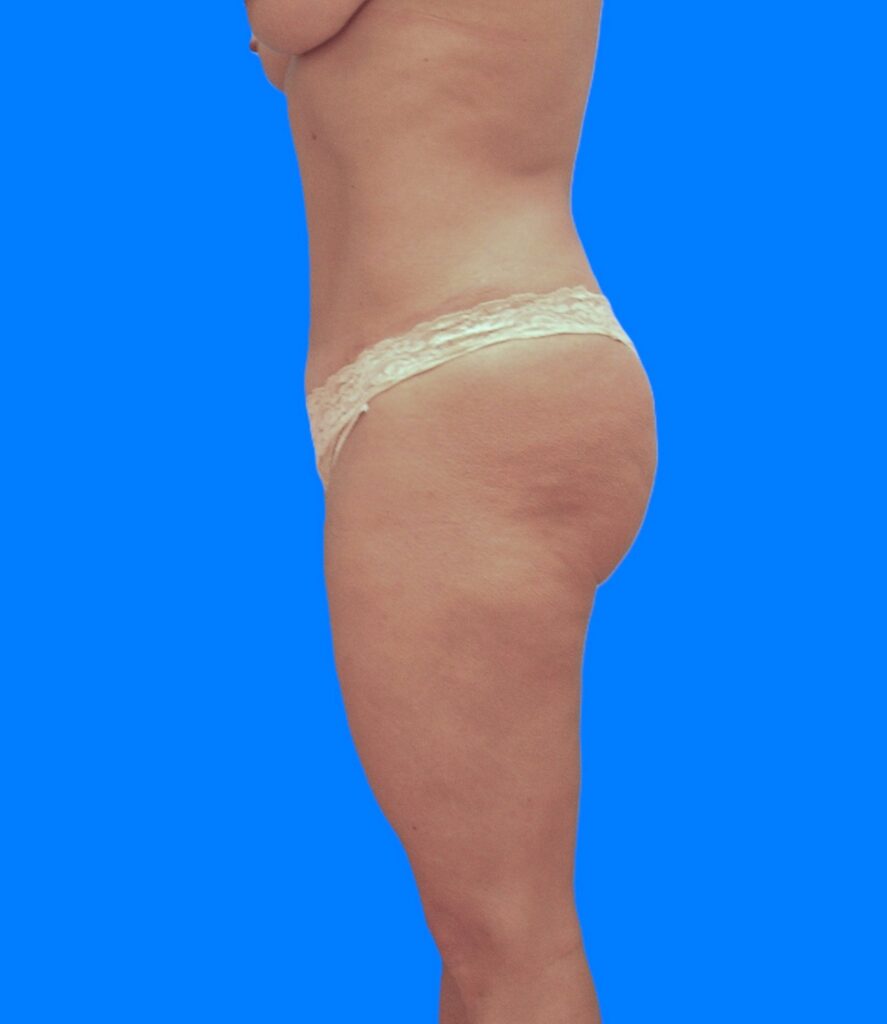 After Image: Patient Case #1182 - left-side