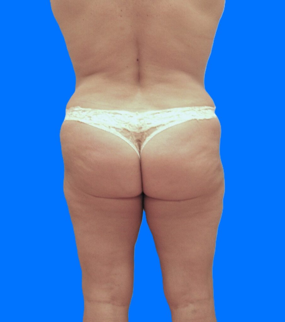 After Image: Patient Case #1182 - back