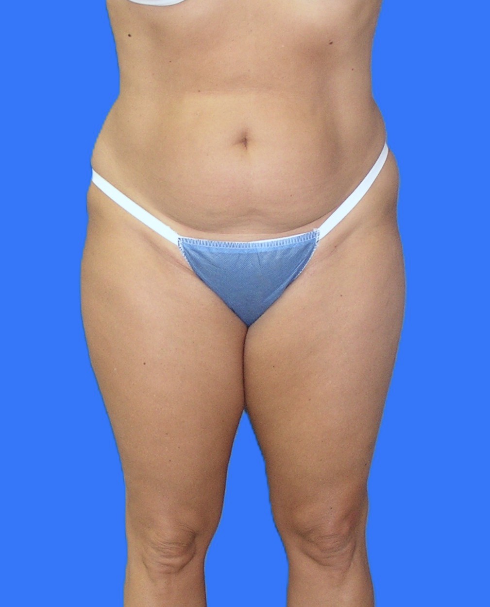 Before Image: Patient Case #1182 - front