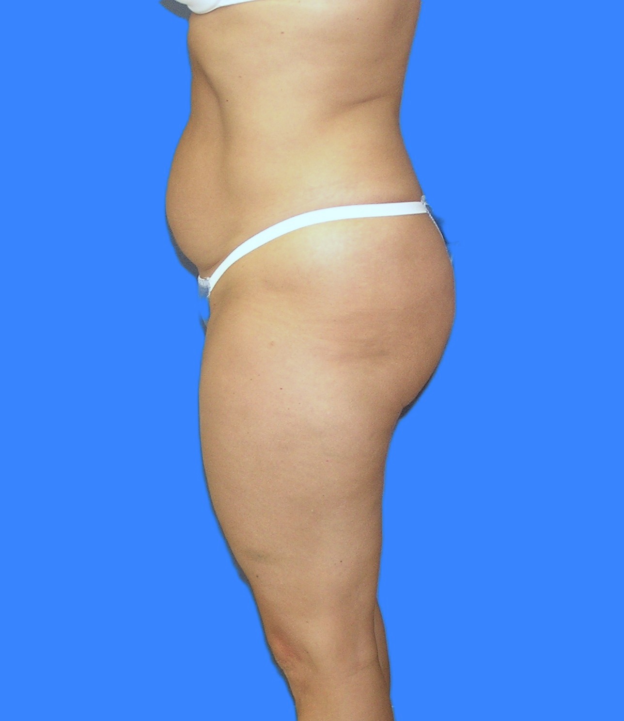 Before Image: Patient Case #1182 - left-side