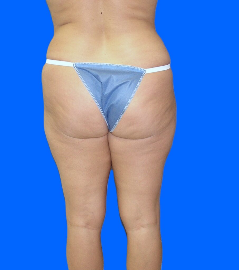 Before Image: Patient Case #1182 - back