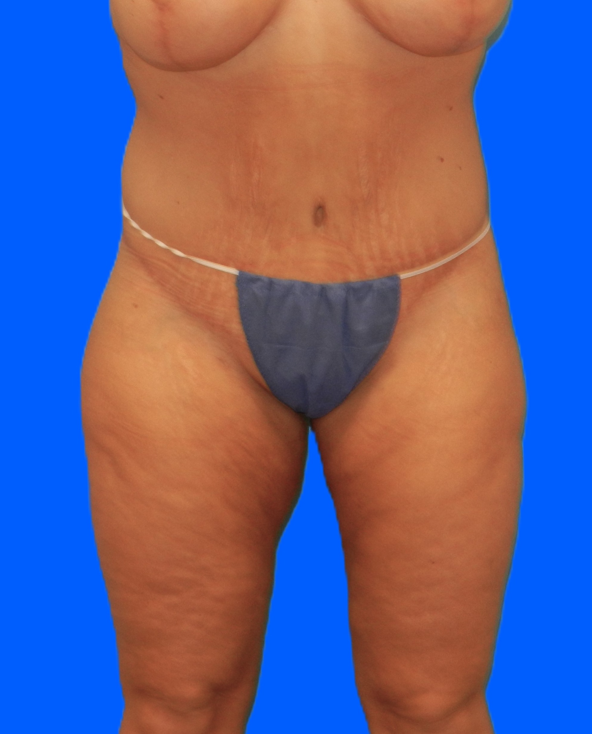 After Image: Patient Case #1298 - front