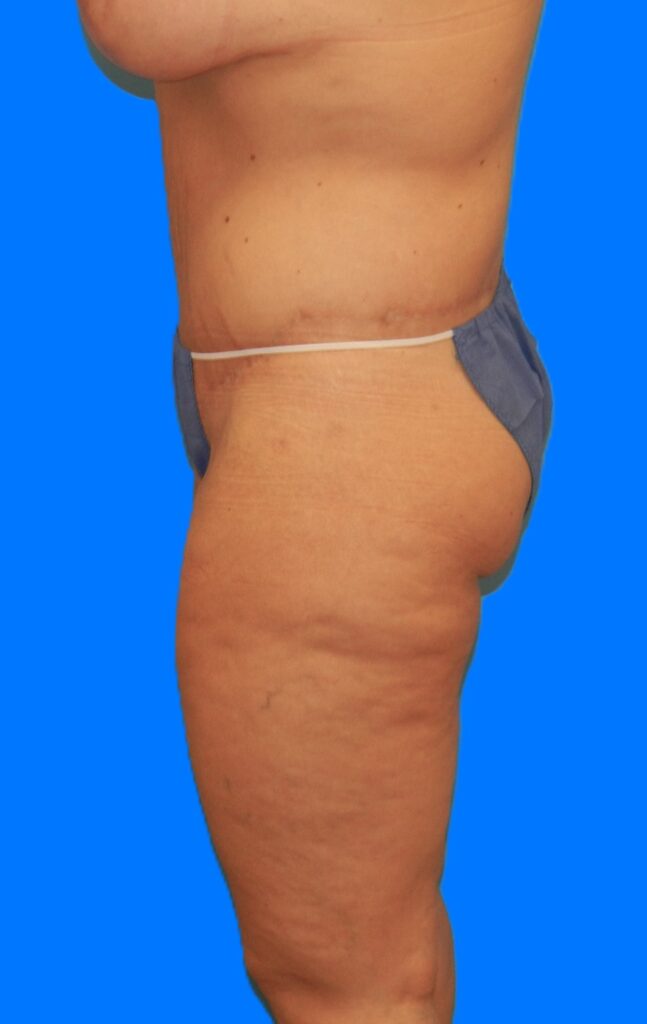 After Image: Patient Case #1298 - left-side