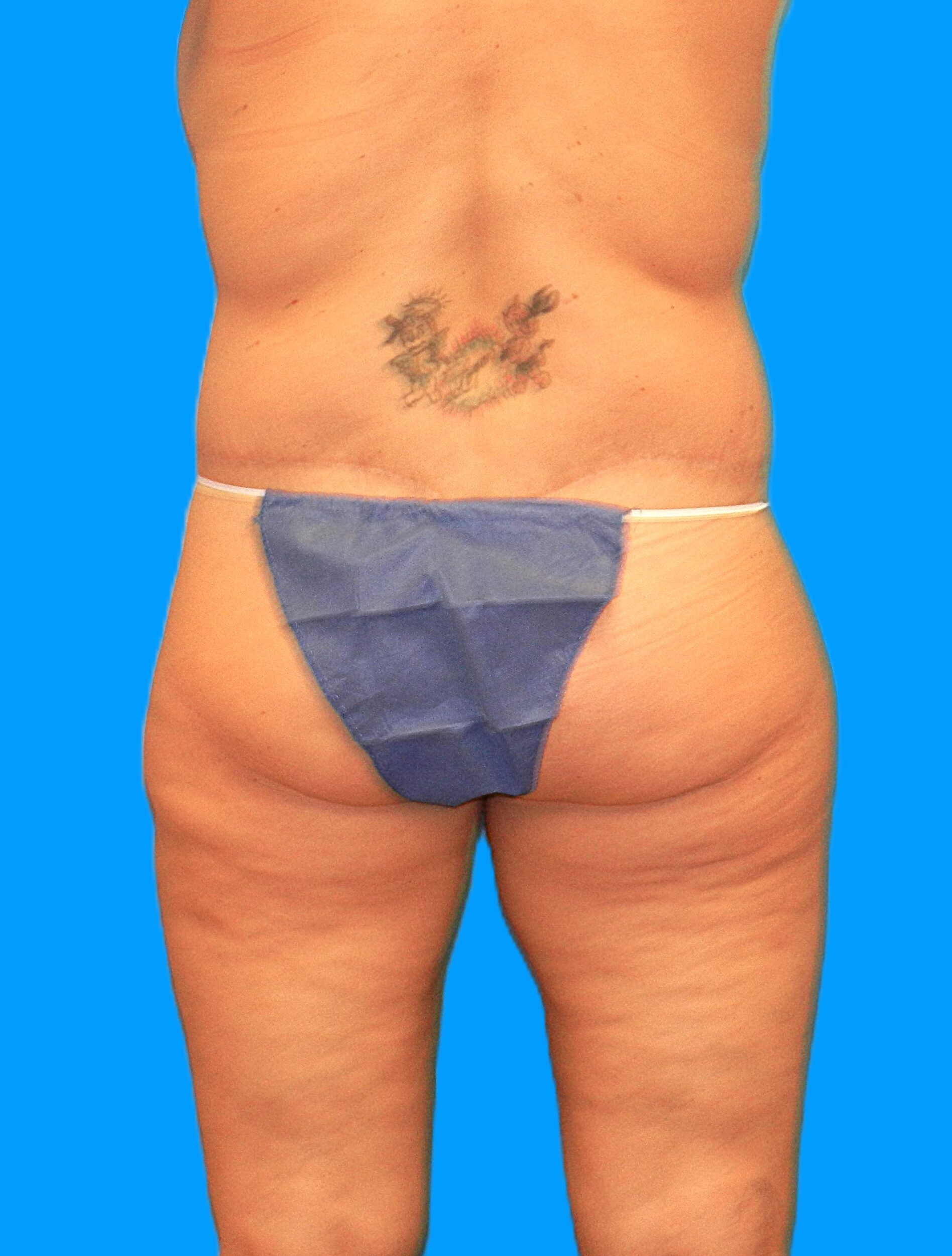 After Image: Patient Case #1298 - back