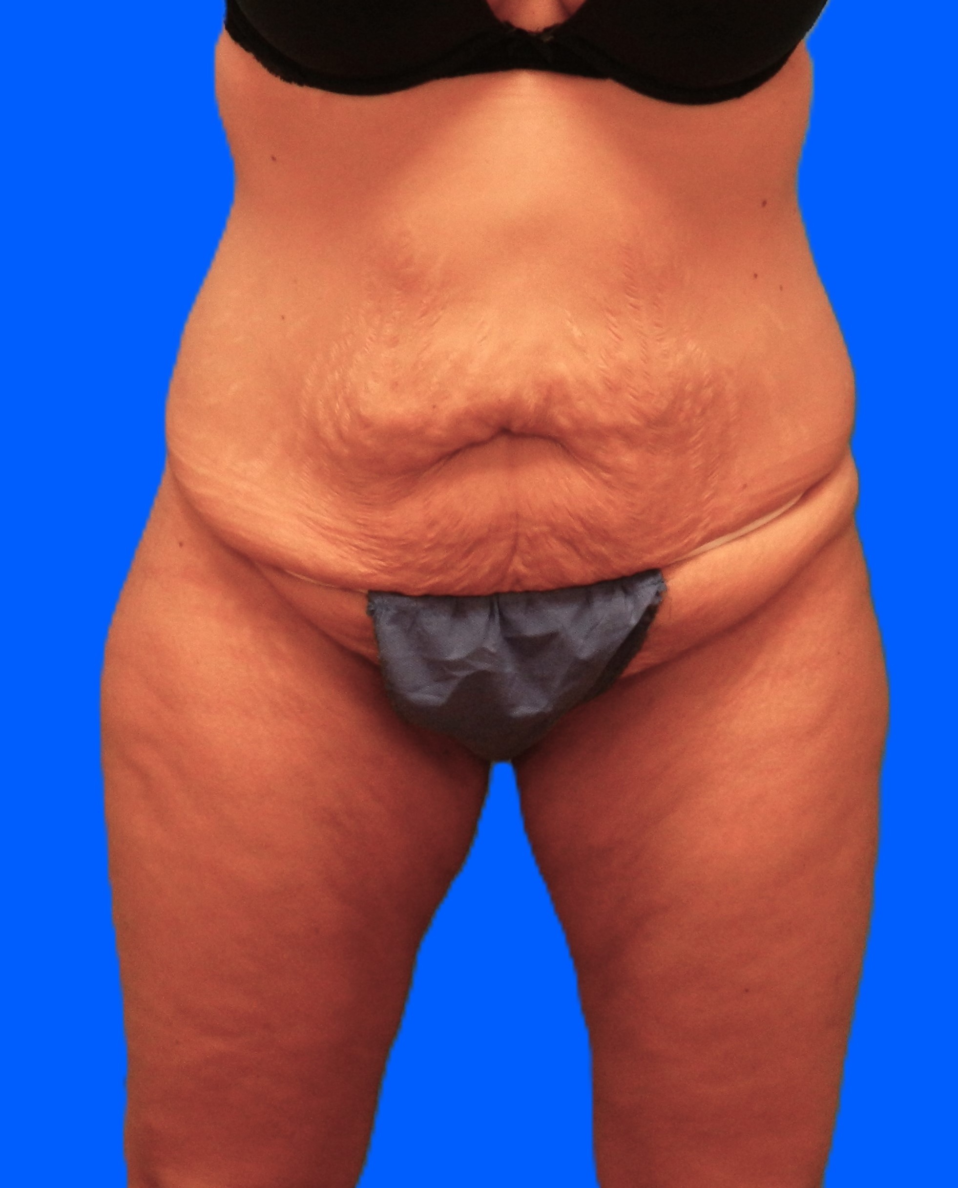 Before Image: Patient Case #1298 - front