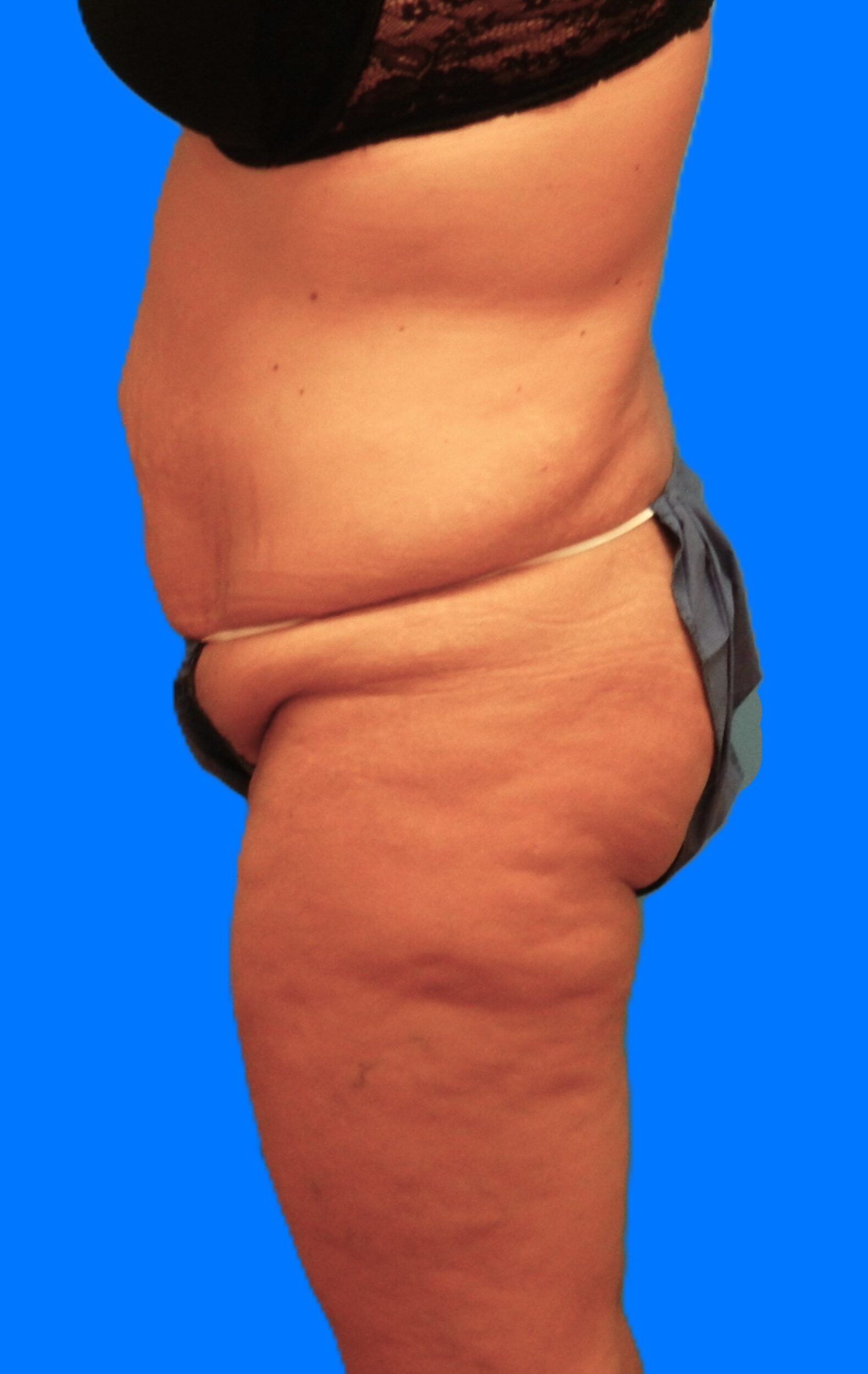 Before Image: Patient Case #1298 - left-side