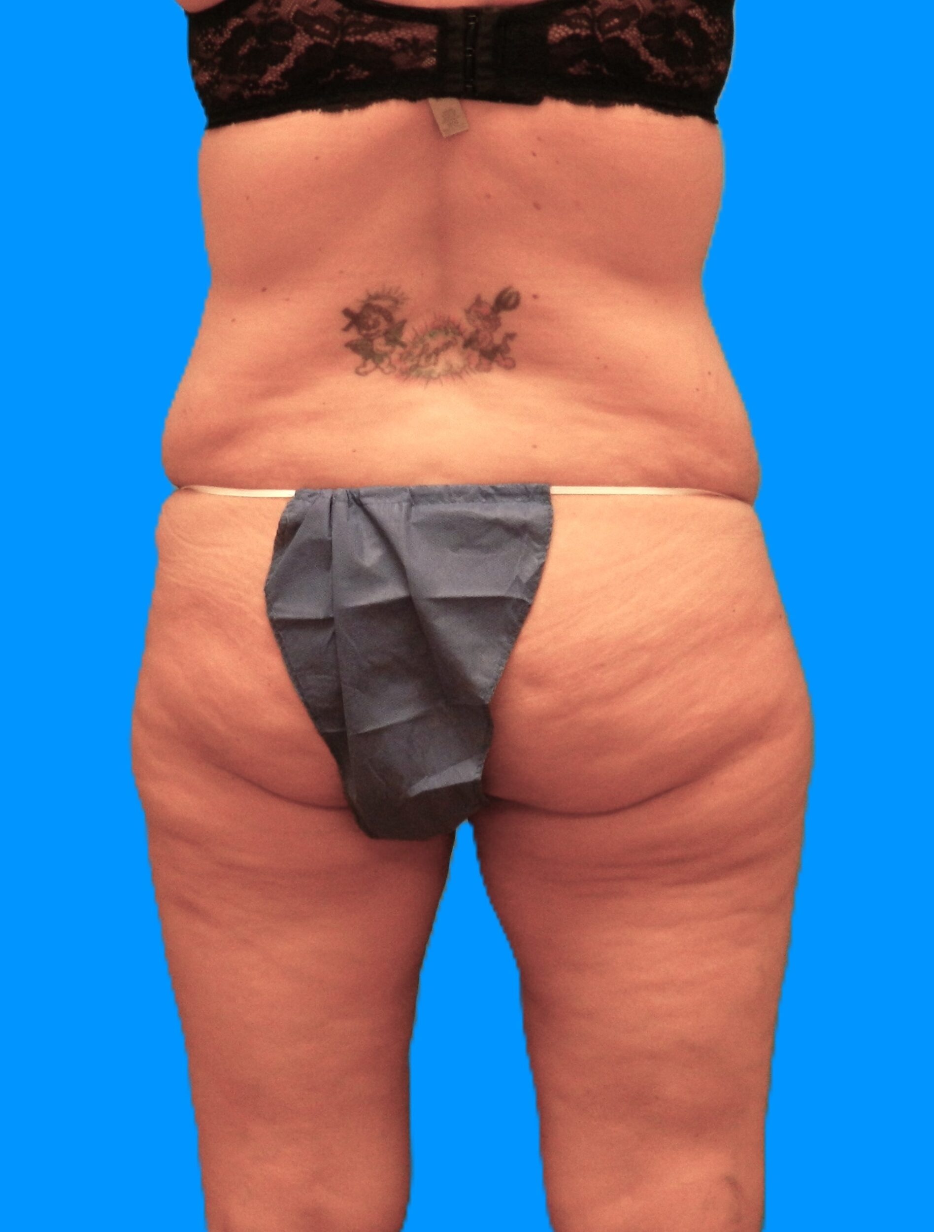 Before Image: Patient Case #1298 - back